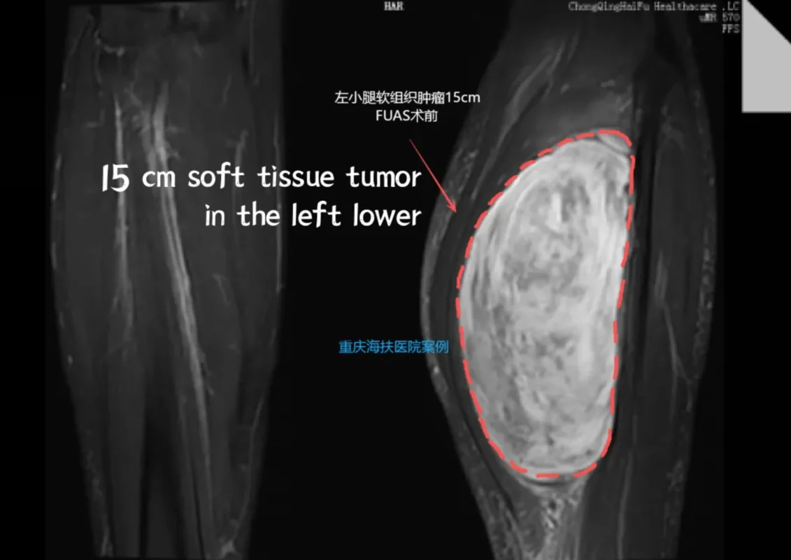 HIFU treatment for soft tissue tumor pre-treatment MRI showing a 15 cm soft tissue tumor in the left lower leg with contrast imaging