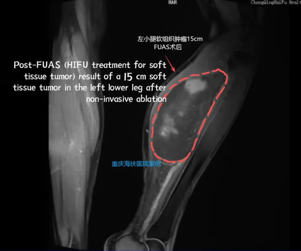 Post-FUAS (HIFU treatment for soft tissue tumor) result of a 15 cm soft tissue tumor in the left lower leg after non-invasive ablation